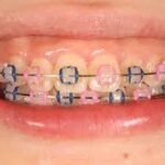 hot pink braces