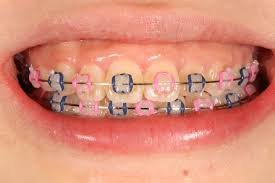 hot pink braces